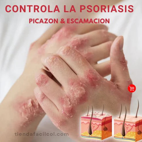 (X2) Psoriasis Treatment Spray