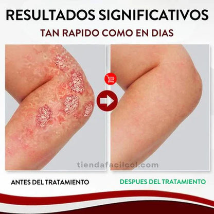 (X2) Psoriasis Treatment Spray